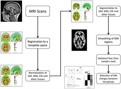 Gray matter, white matter and cerebrospinal fluid abnormalities in Parkinson’s disease: A voxel-based morphometry study